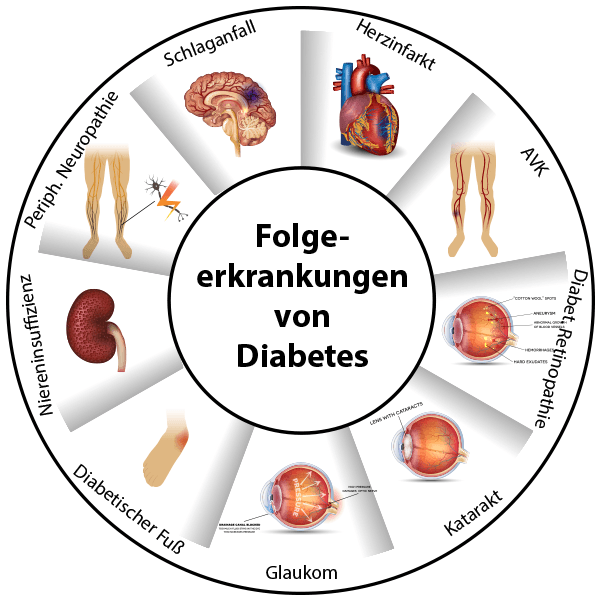 Infographik Folgekrankheiten von Diabetes