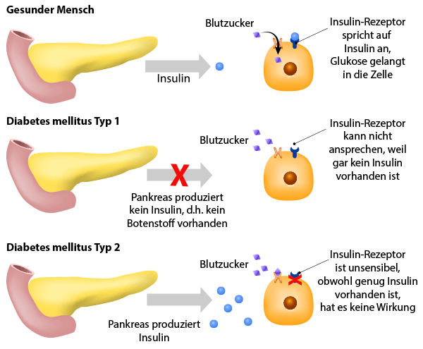 Infographik gesunder Mensch vs. Diabetes Typ 1 vs. Diabetes Typ 2