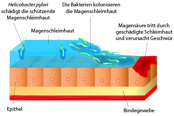 Illustration Entstehung von Gastritis