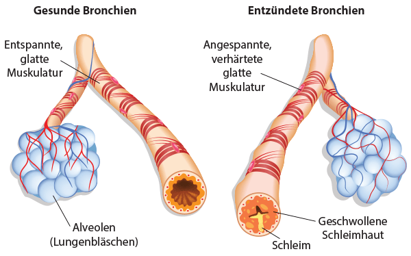 Infografik gesunde und entzündete Bronchien