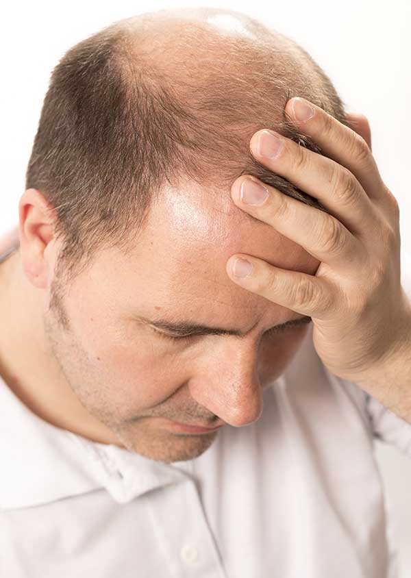 Ein Mann mit Haarausfall (Alopezie)