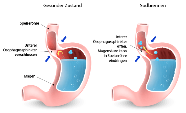 Illustration Entstehung von Sodbrennen